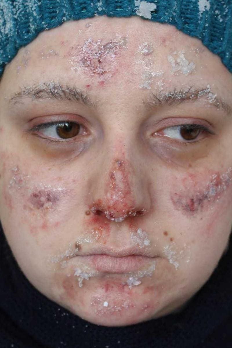 Girl with Frost Bite SFX Makeup